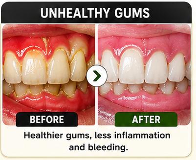 Unhealthy Gums Before and After