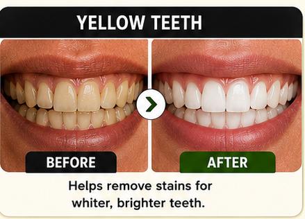 Yellow Teeth Before and After